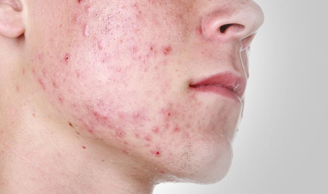 Image result for acne breakouts