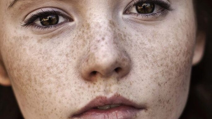 11-home-remedies-to-help-get-rid-of-dark-spots