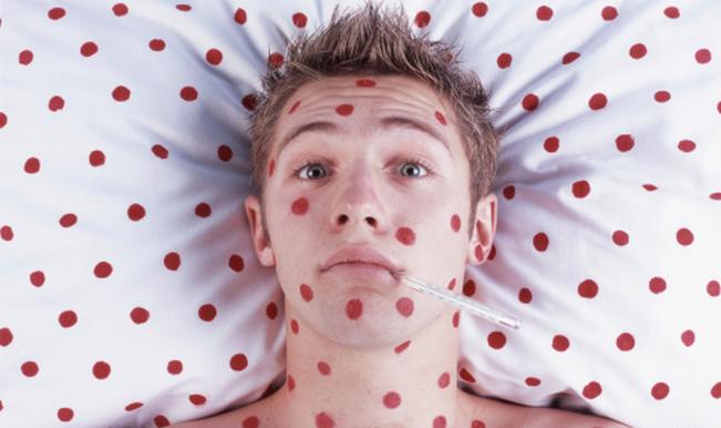 High alert in South Africa for measles outbreak High alert in South Africa for measles outbreak