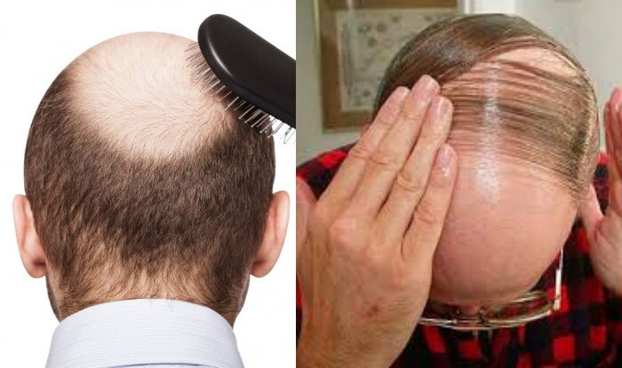 south-korean-scientists-claim-to-have-found-cure-for-baldness-report