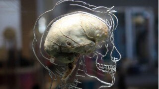 Special drug rushed to help brain-eating amoeba patient in Carolina Special drug rushed to help brain-eating amoeba patient in Carolina