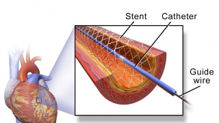 Central government slashes prices of cardiac stents by up to 85%, much-needed relief to lakhs of patients Central government slashes prices of cardiac stents by up to 85%, much-needed relief to lakhs of patients
