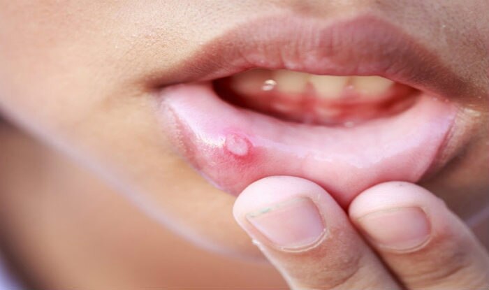 6-superb-home-remedies-to-get-rid-of-mouth-ulcers