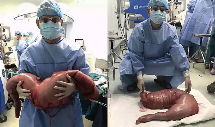 Surgeons Remove Over 28 Pounds of Feces From a Constipated Man | Inverse Surgeons Remove Over 28 Pounds of Feces From a Constipated Man | Inverse