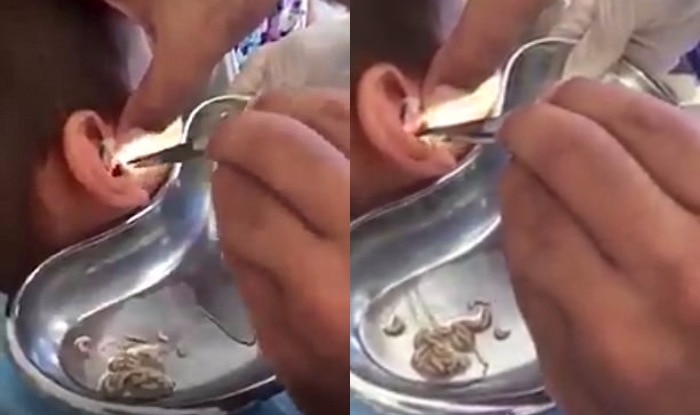 Image result for doctor remove dozens of squirming live MAGGOTS from a boys ear