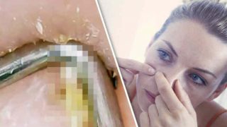 GRAPHIC VID: Blackhead removal in EXTREME close-up is worse than you imagine | ब्लैकहेड हटाने का Video: देखने वालों का चकरा गया सिर! GRAPHIC VID: Blackhead removal in EXTREME close-up is worse than you imagine | ब्लैकहेड हटाने का Video: देखने वालों का चकरा गया सिर!