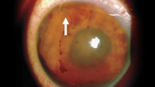 Mexico Doctors Remove Parasitic Worm From 17-Year-Old Boy’s Eye Mexico Doctors Remove Parasitic Worm From 17-Year-Old Boy’s Eye