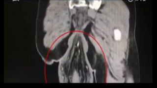 Chinese Man's Rectum Falls Out After He Spent too Much Time Playing on His Phone in the Toilet Chinese Man's Rectum Falls Out After He Spent too Much Time Playing on His Phone in the Toilet