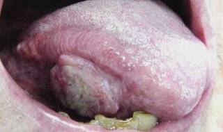 भारतीय डॉक्टरों ने खोजा ओरल कैंसर हटाने का तरीका