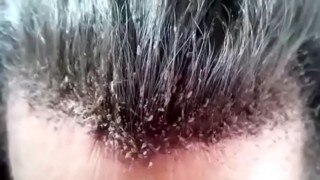 Head full of lice is the weirdest video you will ever see!