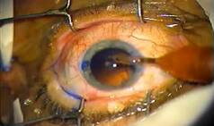 NHRC issues notice to Maharashtra health secretary on botched cataract surgery in Washim