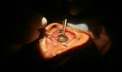 14 lose eyesight due to negligence in Maharashtra's Washim; Doctors suspended