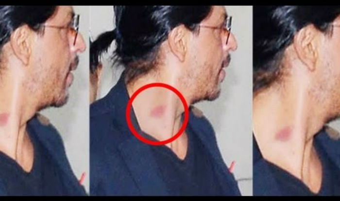 omg shah rukh khan got a love bite india com omg shah rukh khan got a love bite