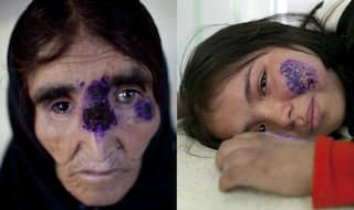 ISIS spreading horrifying 'flesh eating' disease in Syria by dumping dead bodies on streets!