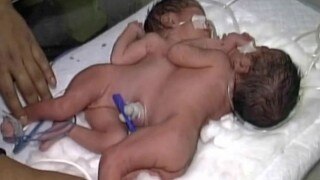 Conjoined twins who share liver born in Agra