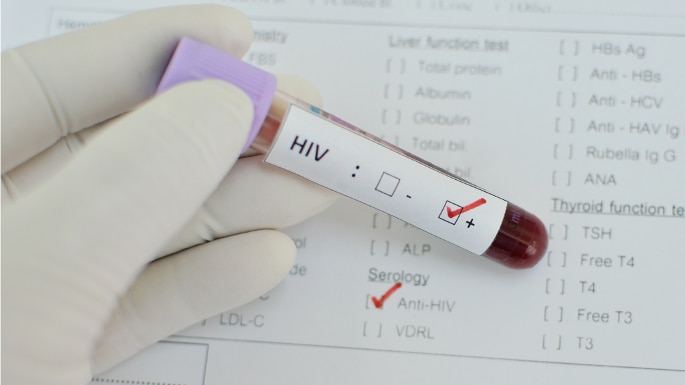 Breakthrough in HIV Cure as Cancer Drug Shows Drastic Results
