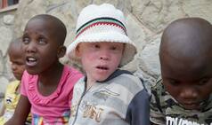 Shocking! Albinos are being abducted, killed, mutilated in Malawi, Africa to use their body parts in superstitious rituals