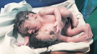 Conjoined twin boys with one heart but 2 heads born in Mumbai hospital