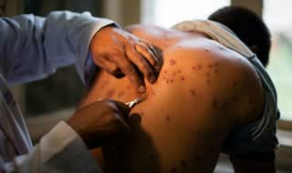 Face of Kashmir's Pellet Gun Victims, Insha Mushtaq Completes Class 10 Board Exams