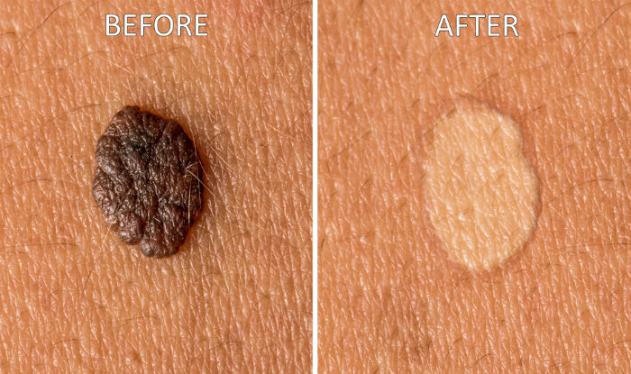 How To Get Rid Of Moles 9 Natural Home Remedies To Remove Moles From 