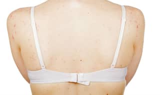 How to get rid of back acne? 11 tips to get rid of pesky bacne