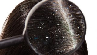 Foolproof Tricks to Clear Your Dandruff