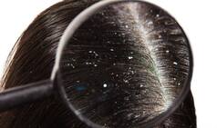 Foolproof Tricks to Clear Your Dandruff