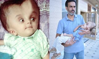 Pakistani Baby with enlarged head undergoes life-saving surgery in US, thanks to a Good Samaritan! (See Pictures)