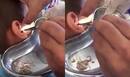 Doctor Removes Dozens of Live Maggots From Kazakhstan Boy's Ears