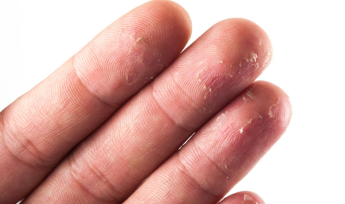 Skin Problems On Fingertips