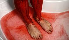 Shocking! Flesh-Eating Sea Bugs leave 16-Year-Old's Legs Chewed and Bloodied