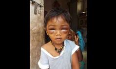 Pune: Tuition Teacher Brutally Beats up 3-year-old; Minor Left With Swollen Face
