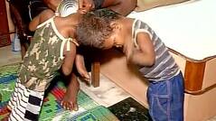 Separated Conjoined Odisha Twin Condition 'Critical' After Over 17 Hours of Surgery