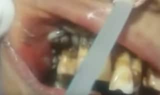 Dentist Opens up Patient's Mouth to Find Slithering Maggots, Video Goes Viral