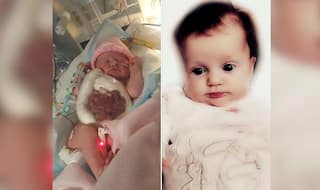 Baby Girl Born With Intestines Outside Her Body Saved Using Clingfilm Wrap: Mother Shares Picture of Brave New Born