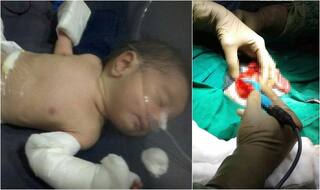 मुंबई के अस्पताल में प्रेग्नेंट' बच्चे का जन्म, पेट में पल रहा था उसका ही जुड़वां भाई