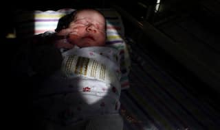 'Mermaid Baby' Born in Kolkata Hospital Dies in Four Hours, Doctors Unable to Identify Sex