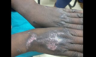 Delhi Dentist Bites, Thrashes, Burns 14-year-old Domestic Help, Arrested