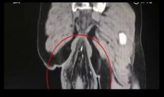 Chinese Man's Rectum Falls Out After He Spent too Much Time Playing on His Phone in the Toilet