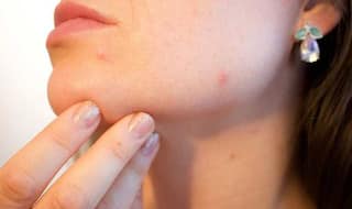 नॉन वेज खाने वाले हो जाएं सावधान, SKIN CANCER बांट रहा है मीट!!