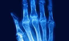 Quit Smoking to Offset Rheumatoid Arthritis Risk, Says Study