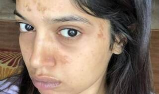 Saand Ki Aankh: Bhumi Pednekar Continues Shooting Despite Having Severe Blisters on Face