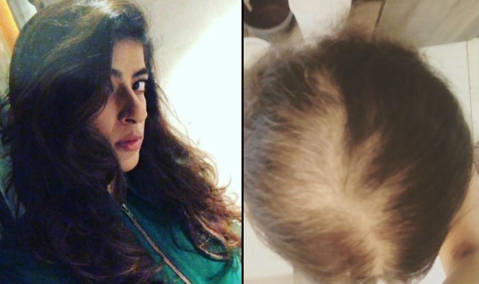 Tahira Kashyap S Latest Instagram Post On Hair Loss Acceptance Is