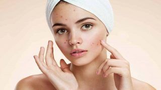Treat Acne And Get a Flawless Skin With This Facial Mask