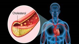 Here is Why You Must Maintain Balance Between Good And Bad Cholesterol Level