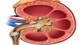 Natural Ways to Dissolve Kidney Stones