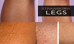 Here is How to Bid Farewell to Strawberry Legs