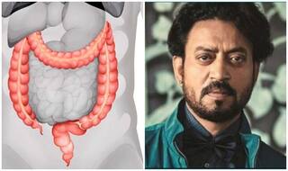 Colon Infection: क्या होता है ये इंफेक्शन जिससे ग्रस्त थे इरफ़ान खान, जानें इसके लक्षण और बचाव के तरीके