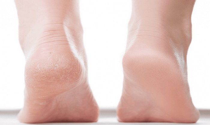 remedy for cracked heels at home