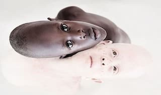 International Albinism Awareness Day 2020: 5 Common Myths Surrounding This Disorder Busted For You